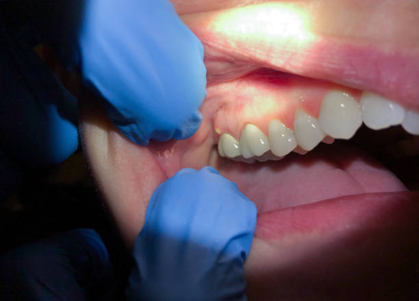 Best Emergency Dental Care for Abscessed Tooth in Fairview, CA